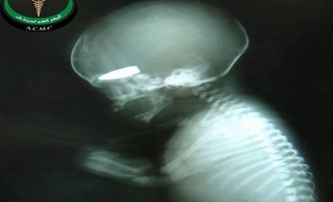 Фотографија:  Игре смрти -  фетус погођен хицем у главу у материци